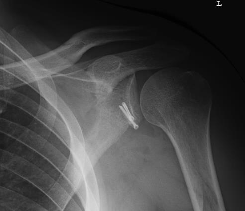 Odtržené kloubní pouzdro je možné rekonstruovat buď za použití artroskopické nebo otevřen operační techniky.