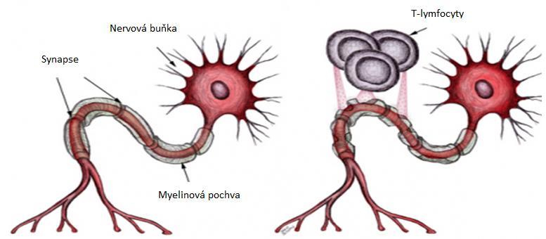 2 Autoimunitní onemocnění Autoimunitní onemocnění vznikají nepřiměřenou reakcí imunitního systému na vlastní struktury, které poškozují.