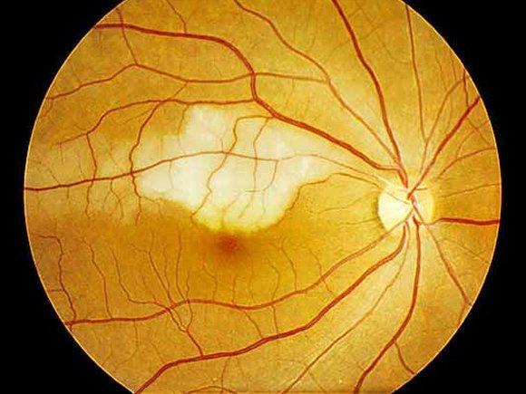 3.1.2 Žilní okluze Vena centralis retinae odvádí krev ze sítnice, provází arterii centralis retinae, pokračuje skrz optický nerv a společně s venou ophthalmicou ústí do sinus cavernosus.