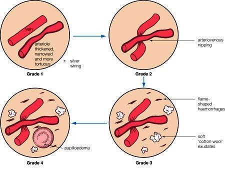 3.3.3 Retinopathia hypertonica Na očním pozadí jsou zřetelná vatovitá ložiska z odumřelých gangliových buněk sítnice.