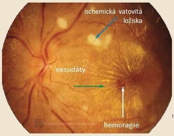 vratné. Naneštěstí zúžení arteriol má změny nevratné. Léčba hypertenze sníží riziko mozkové mrtvice o 40%. (2, 31) Obrázek 7 Hypertenzní retinopatie 3.