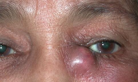 Obrázek 11 - Dakryocystis Obrázek 12 - Orbitální pseudotumor Vážnou komplikací je zánět slzného vaku dakryocystis, při němž dochází k neprůchodnosti slzného kanálu - ductus nasolacrimalis.