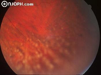 Retina - Častým nálezem je retinální vaskulitida. Na pohled vypadá jako kapky vosku, které vznikly nahromaděním granulomatózní tkáně. Dochází k atrofii a neuritidě zrakového nervu.