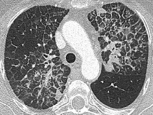 Obr. 22 Obr. 23 Obr. 22. Karcinomatózní lymfangiopatie u pacientky s karcinomem prsu Fig. 22. Carcinomatous lymphagniopathy in patient with breast carcinoma Obr. 23. Poiradiační pneumonitida po radioterapii pro karcinom levého prsu, nález připomíná karcinomatózní lymfangiopatii Fig.