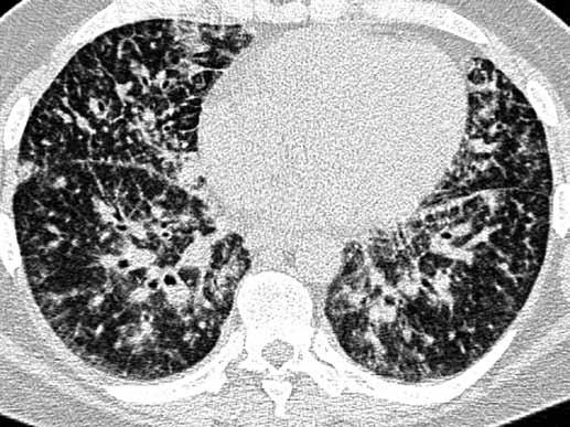 Secondary non-hodgkin lymphoma, mass with air-bronchogramms in the right lower lobe NEJČASTĚJŠÍ ONEMOCNĚNÍ S UZLÍKY V NÁHODNÉ DISTRIBUCI Miliární tuberkulóza Miliární tuberkulóza je charakterizovaná
