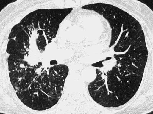 Vzniká při hematogenním šíření mykobakterií u primární i sekundární formy. Typickým nálezem je difuzní rozsev drobných uzlíků velikosti 2 3 mm v náhodné distribuci (obr. 27).