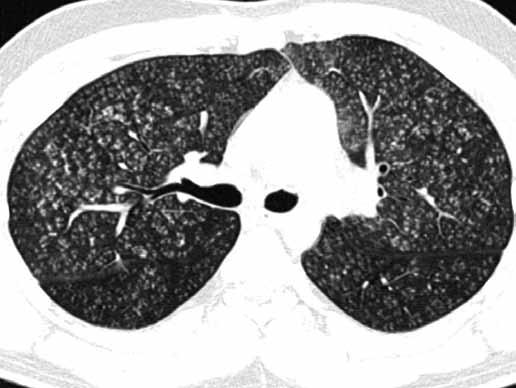 Hypersensitive pneumonitis, subacute stage, diffuse centrilobular well-defined nodules Obr. 34 Obr. 34. Hypersenzitivní pneumonitida, chronické stadium, uzlíky kombinované s fibrózními změnami Fig.