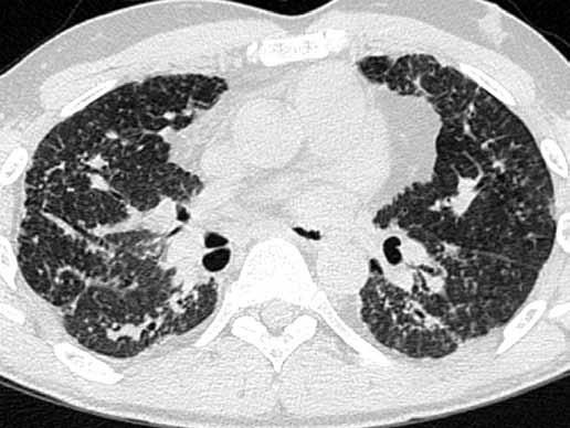 pneumonitida (HP) nebo také exogenní alergická alveolitida je skupina plicních onemocnění způsobených zánětlivou reakcí na úrovni malých dýchacích cest a alveolů způsobenou dlouhodobou inhalací