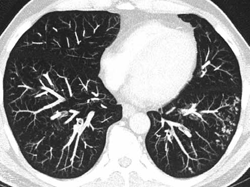 Obr. 35. Bronchioinvazivní aspergilóza u neutropenického pacienta po transplantaci kostní dřeně, centrilobulární uzlíky s obrazem rašícího stromu Fig. 35. Brochoinvasive aspergillosis in neutropenic patient after bone marrow transplantation, centrilobular nodules with tree-in-bud pattern pneumonie.