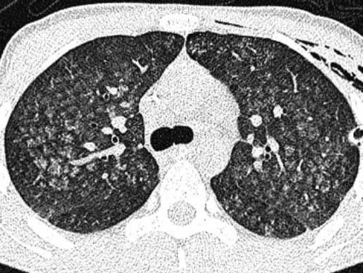 Goodpasture s syndrome, ill-defined centrilobular nodules, drainage of the left pleural cavity je na rozdíl od RB symptomatická.