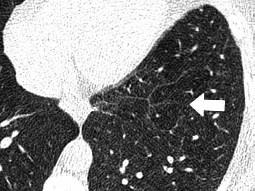 Obr. 2 Obr. 3 Obr. 2. Náhodný nález viditelných interlobulárních sept (šipka) u asymptomatické pacientky bez plicního onemocnění Fig. 2. Incidental finding of visible interlobular septa (arrow) in asymptomatic patient without pulmonary disease Obr.