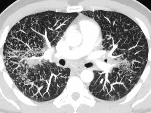 MIP reconstruction shows the distribution of nodules in sarcoidosis better than thin slices (the same patient as in figure 5) Tab. 1.