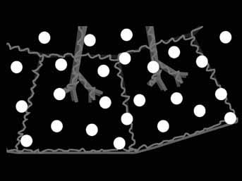8 Obr. 8. Schéma rozložení uzlíků v centrilobulární distribuci Fig. 8. Nodules in centrilobular distribution diagram Obr.