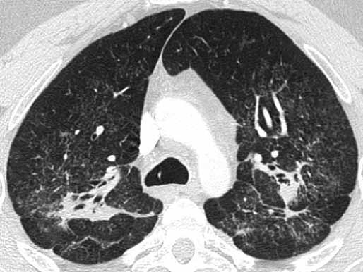 Obr. 10 Obr. 11 Obr. 10. Sarkoidóza, II. stadium, uzlíky v perilymfatické distribuci Fig. 10. Sarcoidosis, stage II, nodules in perilymphatic distribution Obr. 11. Sarkoidóza, II. stadium, shluky uzlíků vytvářející příznak galaxie Fig.