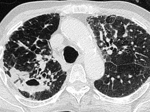 Skořápkovité kalcifikace v uzlinách u silikózy Fig. 19. Egg-shell calcifications in lymph nodes in silicosis Obr. 20.
