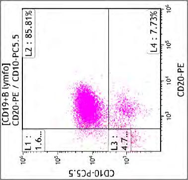 aktivace (HLADR ) FCM závěr: B NHL, vzhledem CD10+