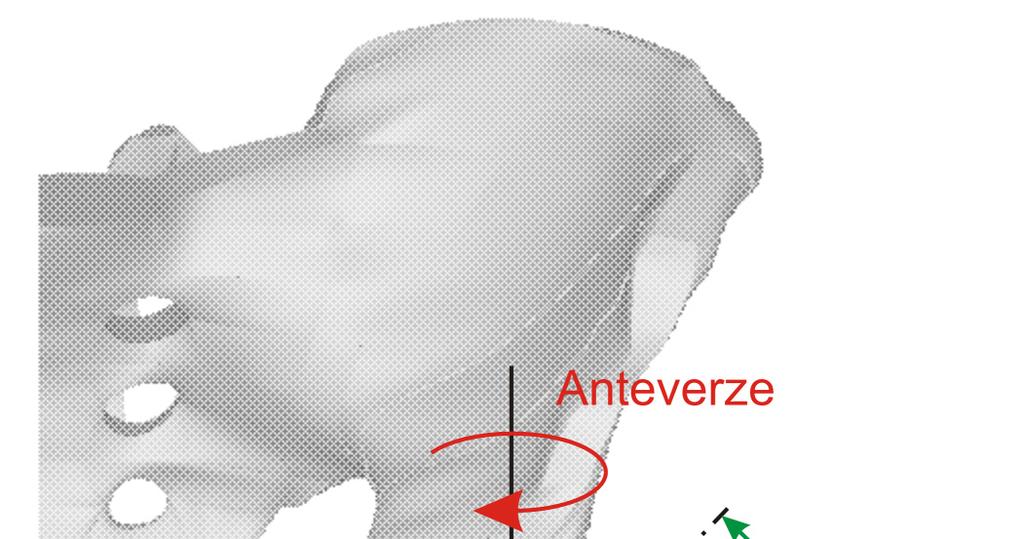 2.3 IMPLANTACE TEP Jak ukazují klinické výsledky, zásadní význam na velikost polyethylenového otěru má přesnost usazení acetabulární polyethylenové komponenty během operačního zákroku [2].