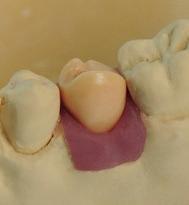 Krok 3 Modelace wax-upu Navrhněte wax-up dle požadované anatomické situace. Můžete navrhnout redukovaný nebo plně anatomický design v závislosti na materiálu a indikaci.