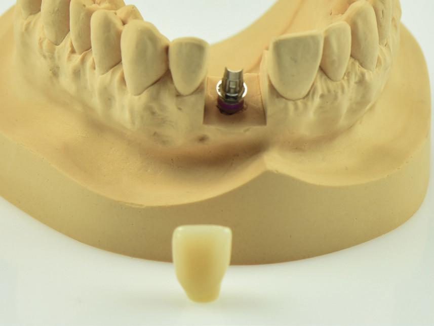 Krok 6 Výroba protetické náhrady Používejte standardní výrobní postupy pro presování či odlevání. Můžete zhotovit plně anatomickou či redukovanou korunku.