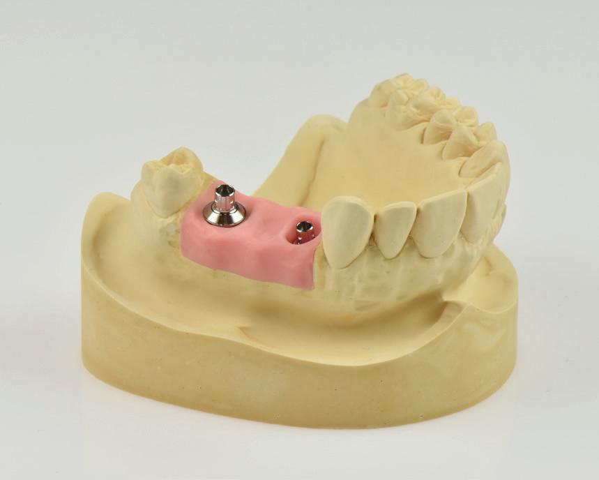 2.3.3 Abutment Variobase pro můstky/ třmeny K dispozici jsou dva typy abutmentů Variobase pro můstky/ třmeny pro