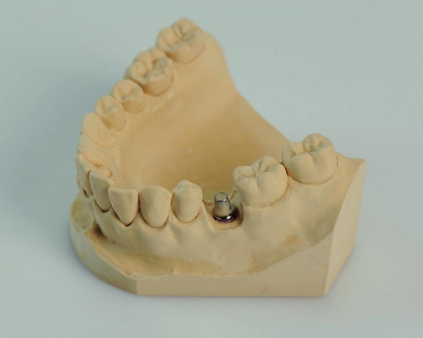 Krok 2 Lepení Aplikujte dentální samolepící cement na abutment Variobase korunkový nebo Variobase korunkový AS.