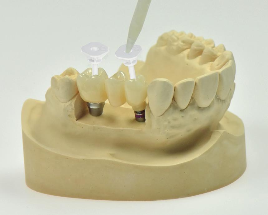 Krok 3 Nasazení pomocného nástroje pro cementování před nasazením pomocného nástroje, abutment Variobase pro můstky/