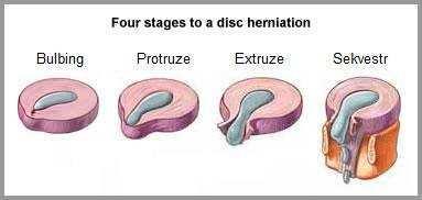 Obr. 3: Stádia herniace disku (www.google.cz) 1.6. RIZIKOVÉ A PREDISPONUJÍCÍ FAKTORY U výhřezu meziobratlové ploténky se předpokládá určitý genetický vliv.