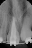 (17). Také je popsáno, že maturogeneze má vyšší úspěšnost, co se radiologického přírůstku tkání týče, u mladších pacientů (18, 19) a zubů s nižšími vývojovými stupni vývoje kořene (19).