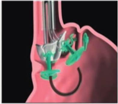 Endoskopické restriktivní implantáty Transorální endoskopický restriktivní systém (TERIS, BaroSense, Redwood, CA, USA) aplikuje