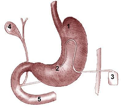 Gastrická elektrostimulace-implantable gastric stimulation (IGS) V roce 1994 Cigaina (43) navrhl elektrostimulaci žaludku k vyvolání inhibice normální žaludeční peristaltiky a tím navození pocitu