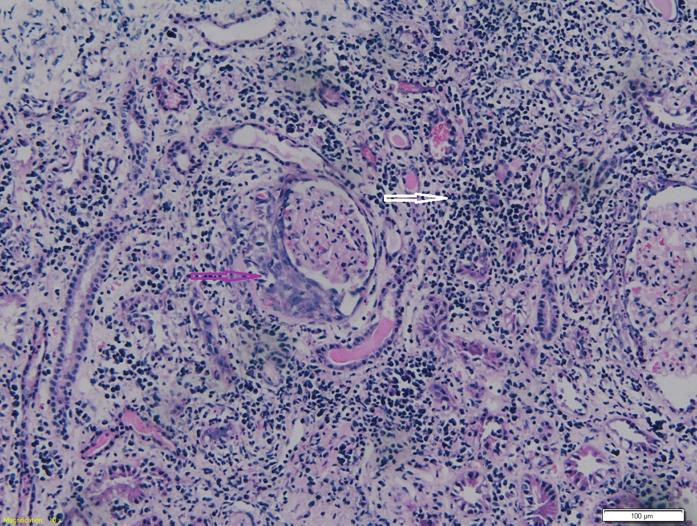 HLAVNÍ TÉMA Polékové poškození ledvin Obr. 4. Akutní nekrotizující pauciimunní glomerulonefritida se srpky. Nekróza a celulární srpky glomerulu (fialová šipka), subakutní TIN (bílá šipka) Obr. 5.