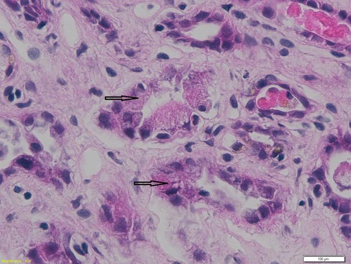 Precipitace krystalů v tubulech s fibrózou intersticia (tmavě červená šipka) Glomerulopatie zprostředkovaná imunitní reakcí Imunitně zprostředkovaná glomerulopatie je vyvolána tvorbou protilátek
