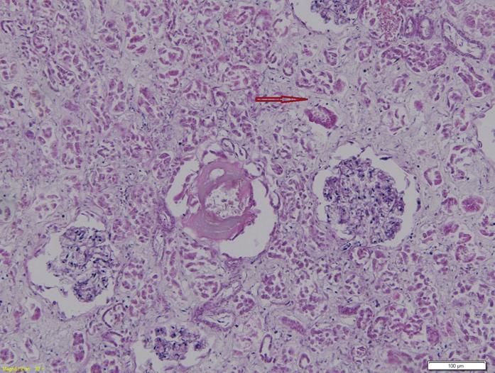 Řadíme sem vaskulitidy způsobené buď přímo protilátkami, imunitními komplexy či vaskulitidy vyvolané protilátkami proti komponentám cytoplazmy neutrofilů (ANCA).