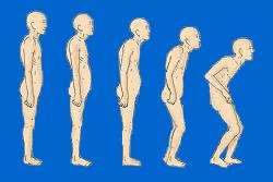 Ve stáří a při p i některých n chorobách převažuje odbourávání kosti nad její novotvorbou kosti řídnou osteoporosa nejvíce jsou