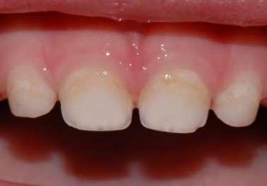 provedeno čištění a leštění zubů (Cleanic) a fluoridace postižených míst fluoridovým lakem (Bifluorid 10).