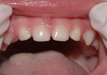 Rodiče zvládali hygienu dutiny ústní dobře, plak nebyl detekován. Druhá fluoridace postižených míst byla opět fluoridovým lakem (Bifluorid 10).