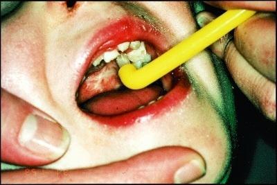 K čištění dočasných zubů je doporučován malý dětský kartáček a jednosvazkový kartáček. Nízký úpon slizniční řasy v místě rozštěpu brání dosáhnout klasickému zubnímu kartáčku distálních úseků chrupu.