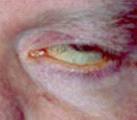 (hordeolum, chalazion), nádor dermatochalasis lagoftalmus