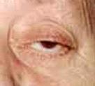 hordeolum chalazion nádor Spojivky dolná spojivka sa