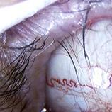 (začervenianie) priehladnosť - pterygium (prerastanie na