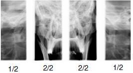 Dvojitý laterální PA Laterální (1/2) a posterior-anterior (2/2) snímkování otevřených anebo zavřených