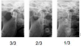 3 úhly lateral Tři laterální snímky při 3 úhlech pravého anebo levého TMJ. Úhel snímkování snímku č.
