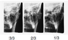 7 PROGRAMY 3 úhly PA Tři posteriori-anterior snímky pravé anebo