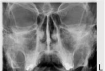 3 Snímkování Sinus Posterior-anterior PA Sinus expozice