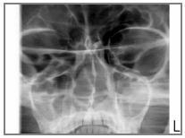 11 SNÍMKOVÁNÍ SINUS 11.5 Snímkování TMJ program při 3 úhlech Ujistěte se, že jste vybrali správného pacienta a snímkovací mód v programu Planmeca Romexis. 1. Stiskněte symbol záření nebo tlačítko Dopředu.