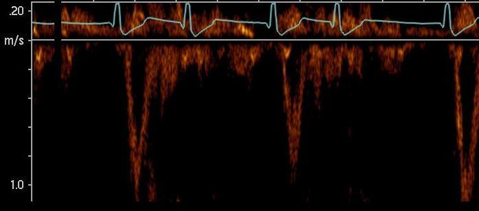 Pulzové deficity Méně pulzů než srdečních úderů Patologický rytmus srdeční, s údery bez ejekčního objemu (nebo omezeným ej. obj.) : proto VYNECHÁNÍ PULZOVÉ VLNY.