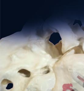 Fusion for the Future: SI-LOK SACROILIAC JOINT FUSION SYSTEM Up to 25% of Low Back Pain Originates in the