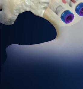 screws are available with a slot for autogenous bone graft, designed to optimize sacroiliac joint fusion.