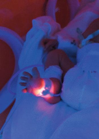 ROČNÍK 22/2016 ČÍSLO 1 NEONATOLOGICKÉ LISTY Česká neonatologická