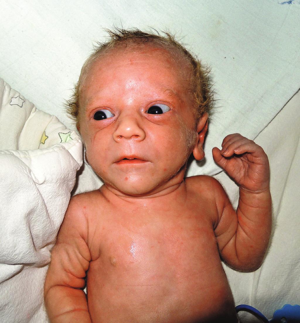 NEONATOLOGICKÉ LISTY, 22/2016, číslo 1 Od 4. dne byl chlapec na plném perorálním příjmu, prospíval na váze. Nicméně i po porodu přetrvávala tachykardie 160 180 pulzů za minutu.